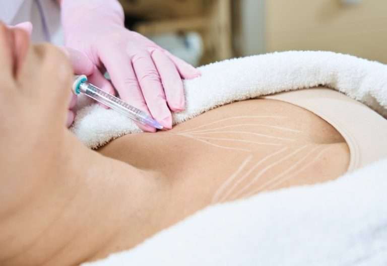 Mujer recibiendo tratamiento facial de bioestimuladores de colágeno para rejuvenecimiento de la piel